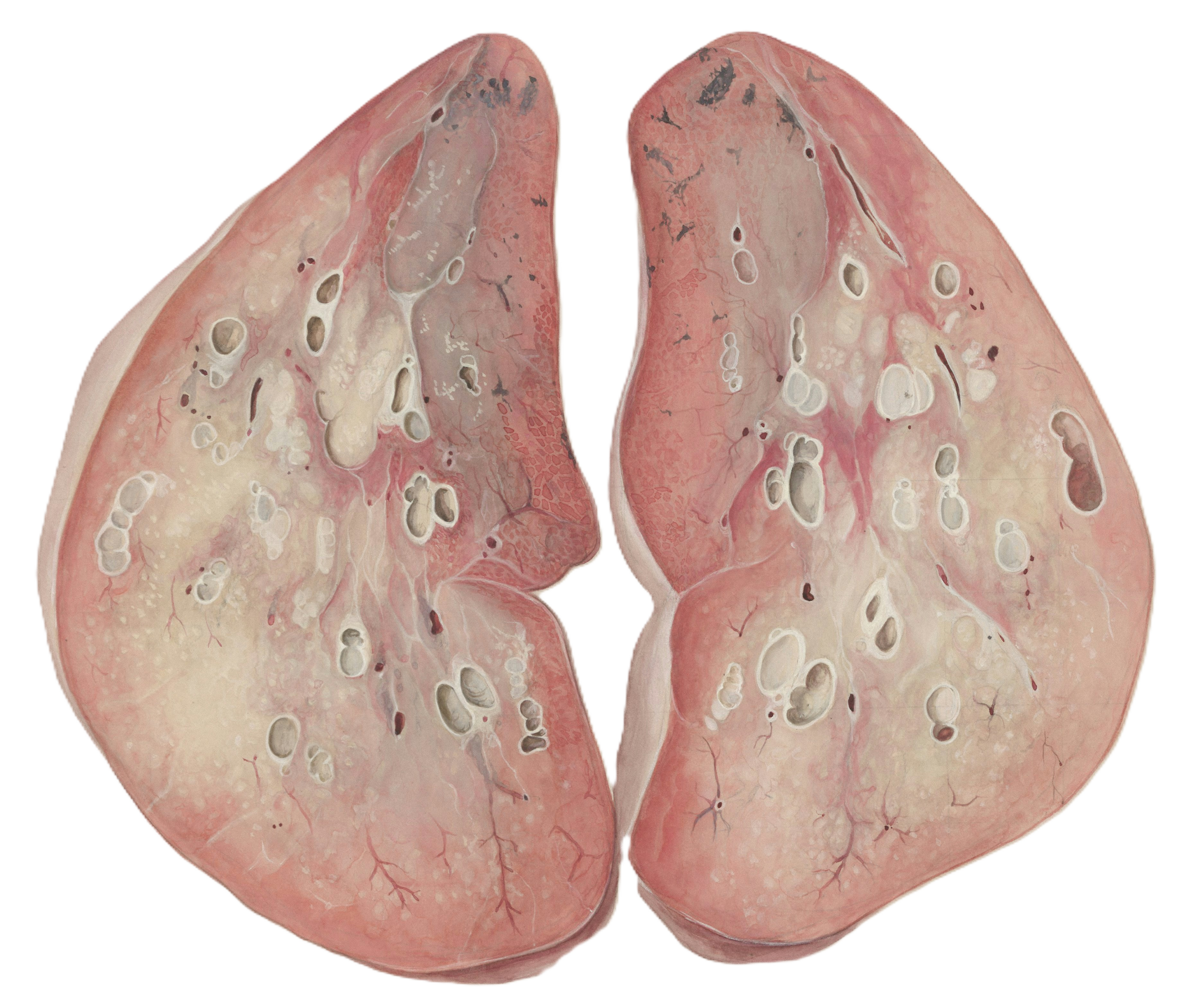 Medical illustration representing advanced-stage lung cancer.