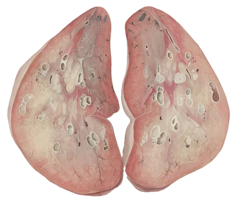 Medical illustration representing advanced-stage lung cancer.