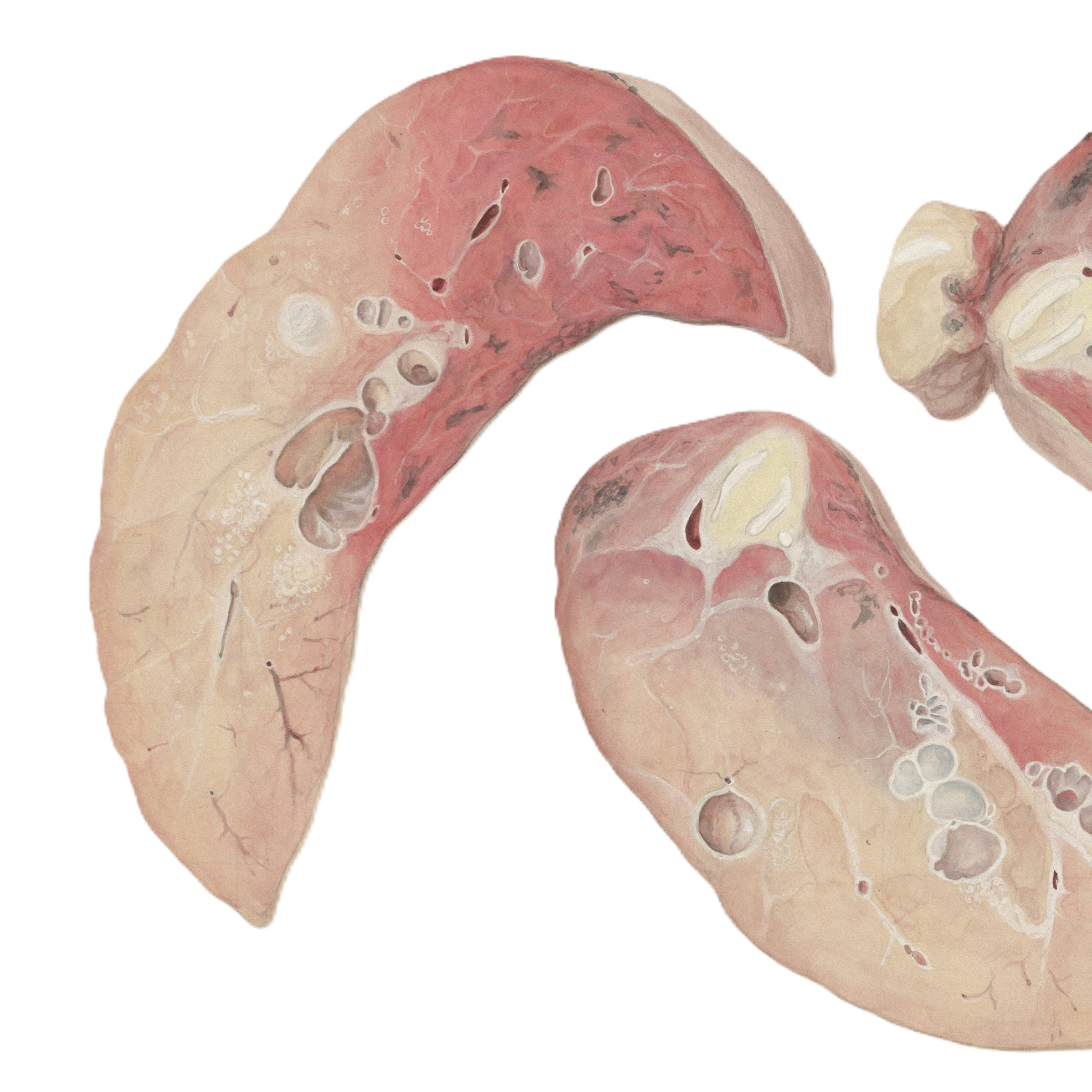 Medical illustration representing pulmonary tuberculosis research.